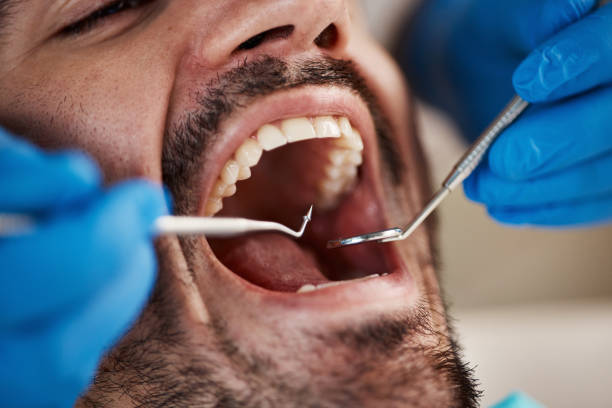 Best Emergency Tooth Extraction in White City, UT